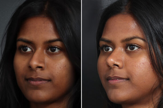 Rhinoplasty Before and After Photos in Princeton, NJ, Patient 22302