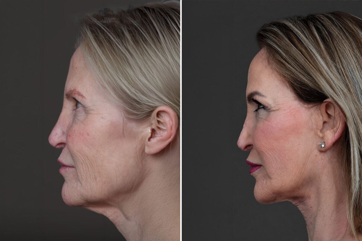 Deep Plane Facelift Before and After Photos in Princeton, NJ, Patient 22305