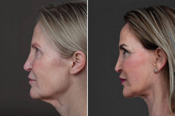 Deep Plane Facelift Before and After Photos in Princeton, NJ, Patient 22305