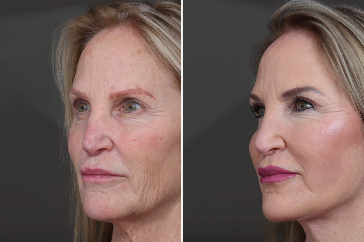 Deep Plane Facelift Before and After Photos in Princeton, NJ, Patient 22305
