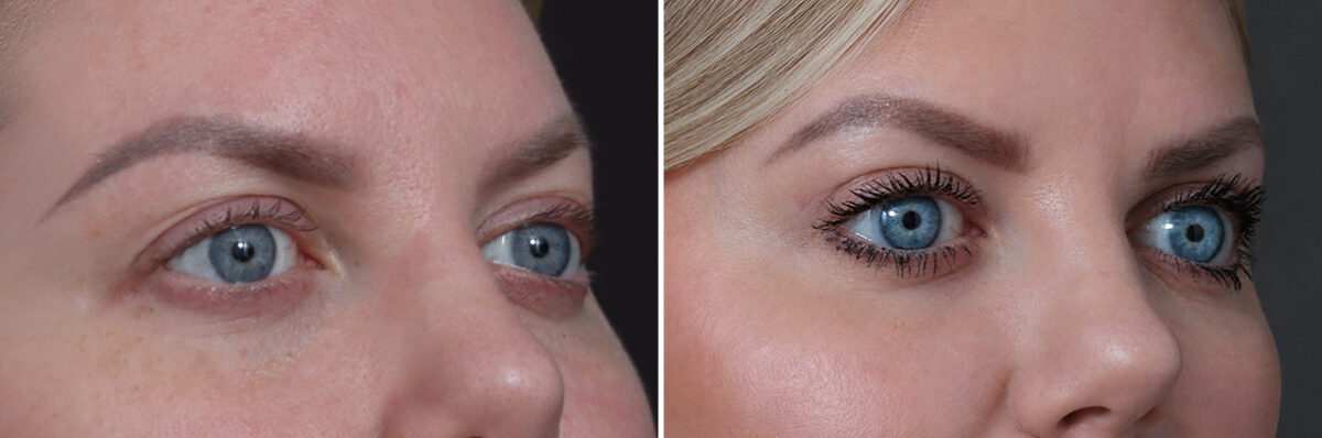 Upper Eyelid Surgery Before and After Photos in Princeton, NJ, Patient 22308