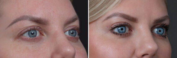Upper Eyelid Surgery Before and After Photos in Princeton, NJ, Patient 22308