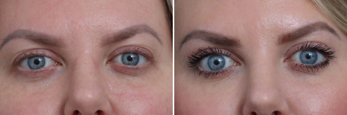 Upper Eyelid Surgery Before and After Photos in Princeton, NJ, Patient 22308