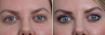 Upper Eyelid Surgery Before and After Photos in Princeton, NJ, Patient 22308