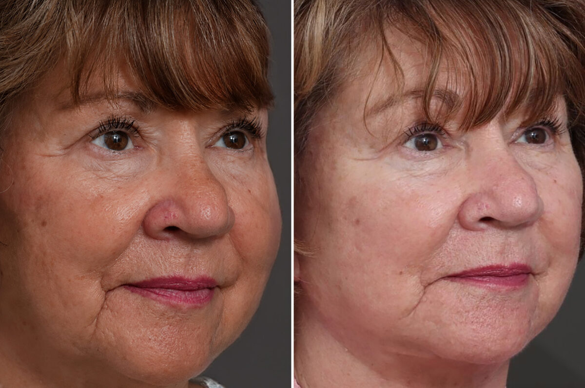 Facelift Before and After Photos in Princeton, NJ, Patient 22351