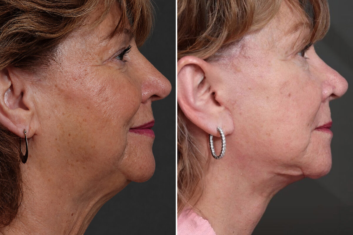 Facelift Before and After Photos in Princeton, NJ, Patient 22351