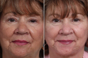 Facelift Before and After Photos in Princeton, NJ, Patient 22351