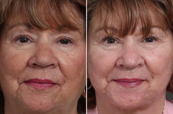 Facelift Before and After Photos in Princeton, NJ, Patient 22351