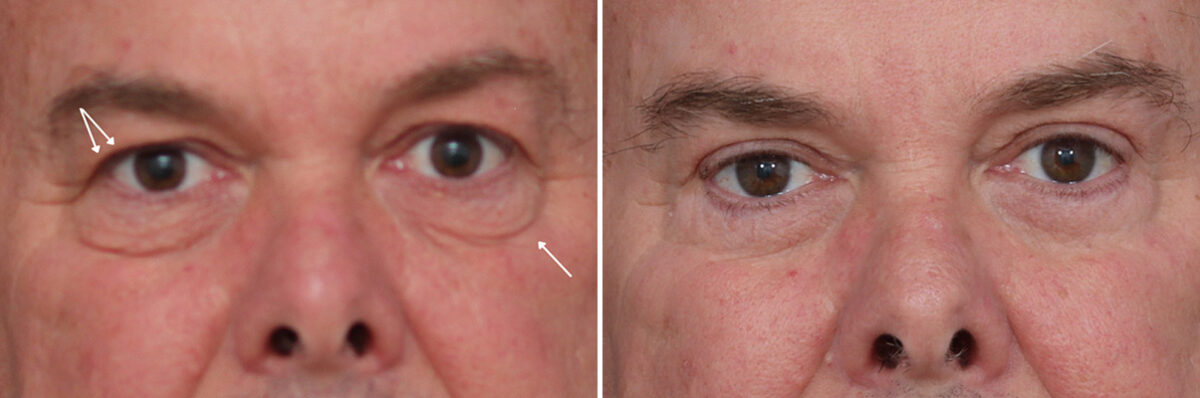 Upper and Lower Eyelid Surgery Before and After Photos in Princeton, NJ, Patient 22355