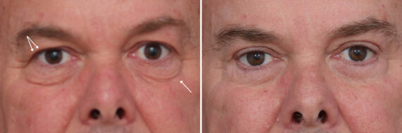 Upper and Lower Eyelid Surgery Before and After Photos in Princeton, NJ, Patient 22355
