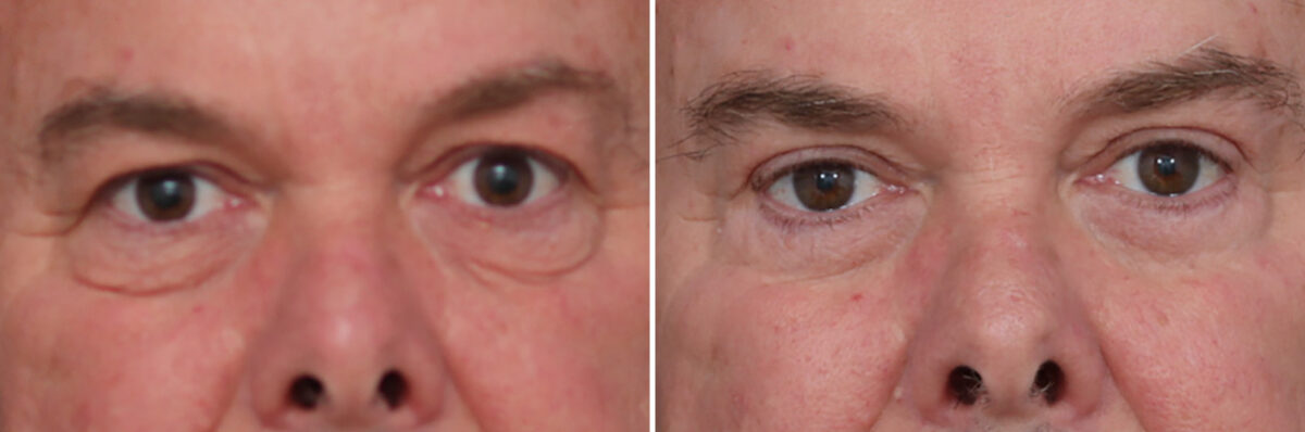 Upper and Lower Eyelid Surgery Before and After Photos in Princeton, NJ, Patient 22355