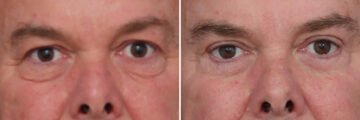 Upper and Lower Eyelid Surgery Before and After Photos in Princeton, NJ, Patient 22355