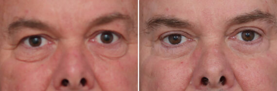 Upper and Lower Eyelid Surgery Before and After Photos in Princeton, NJ, Patient 22355