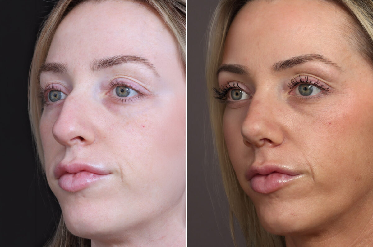 Rhinoplasty Before and After Photos in Princeton, NJ, Patient 22358