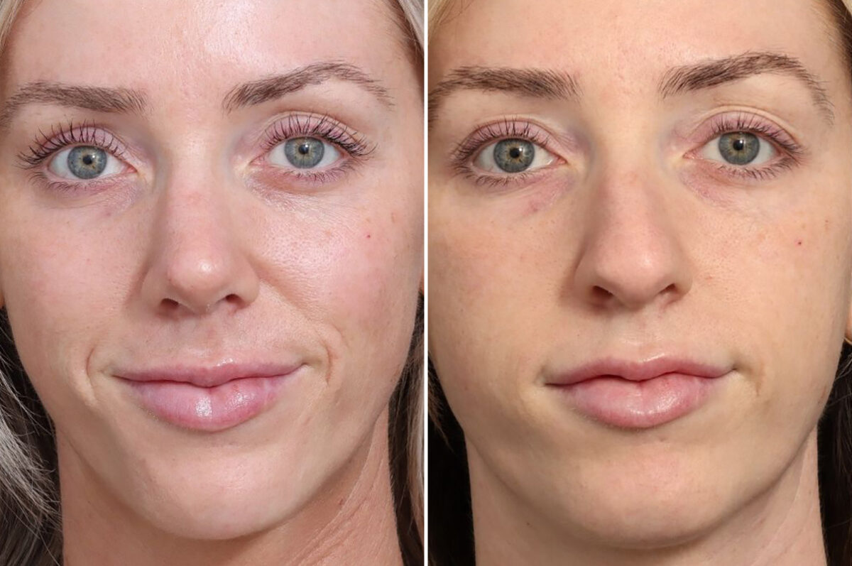 Rhinoplasty Before and After Photos in Princeton, NJ, Patient 22358