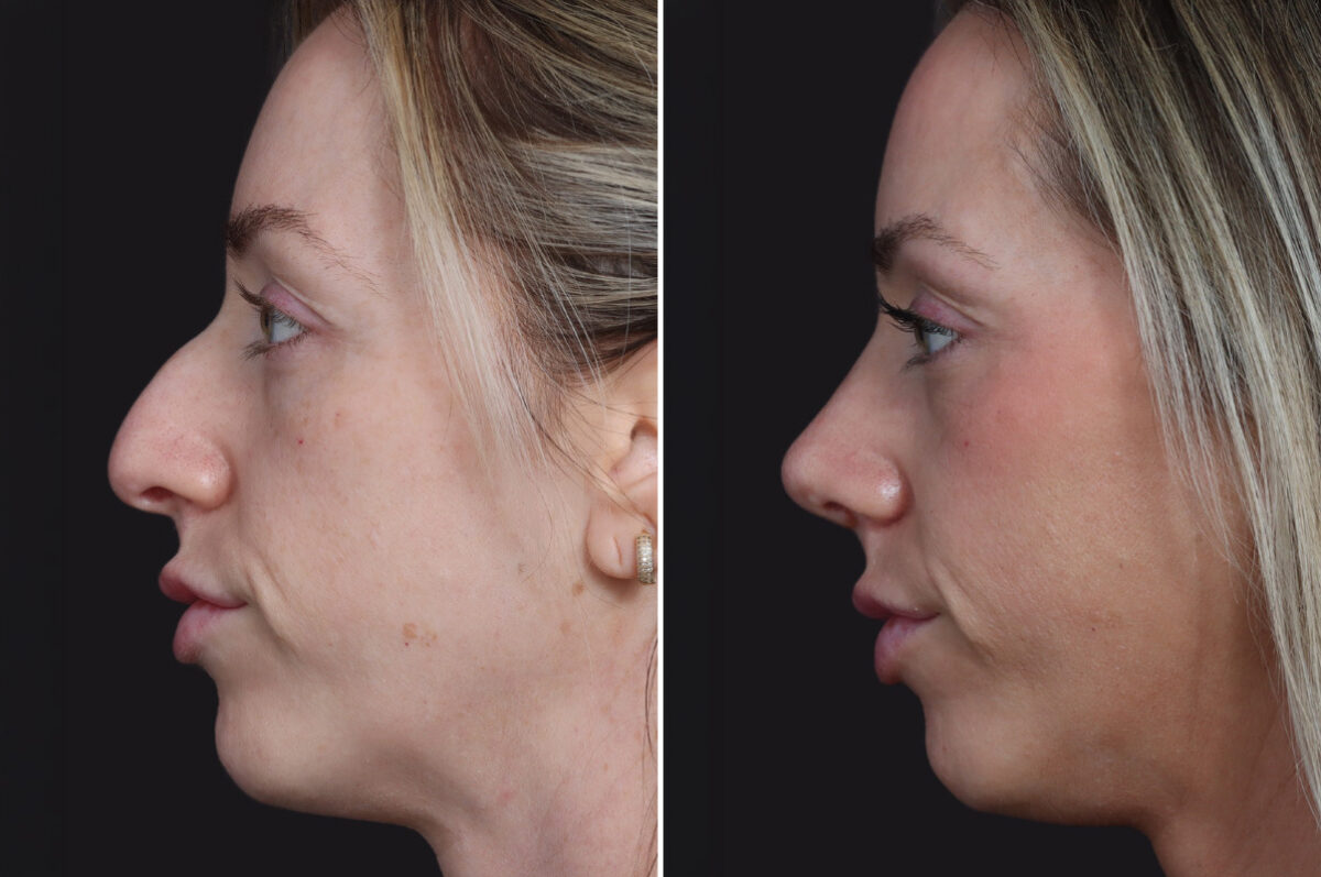 Rhinoplasty Before and After Photos in Princeton, NJ, Patient 22358