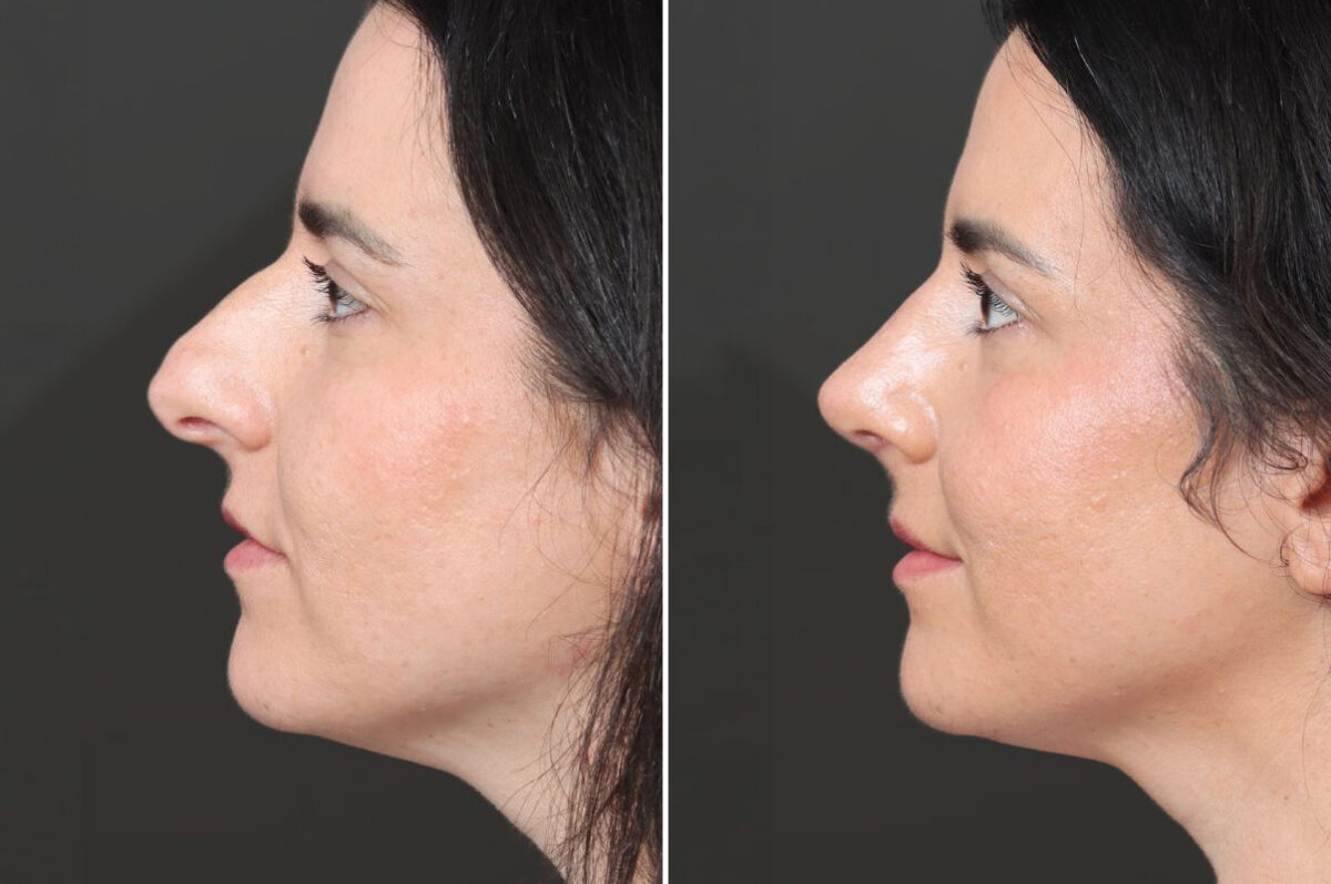 Rhinoplasty Before and After Photos in Princeton, NJ, Patient 22362