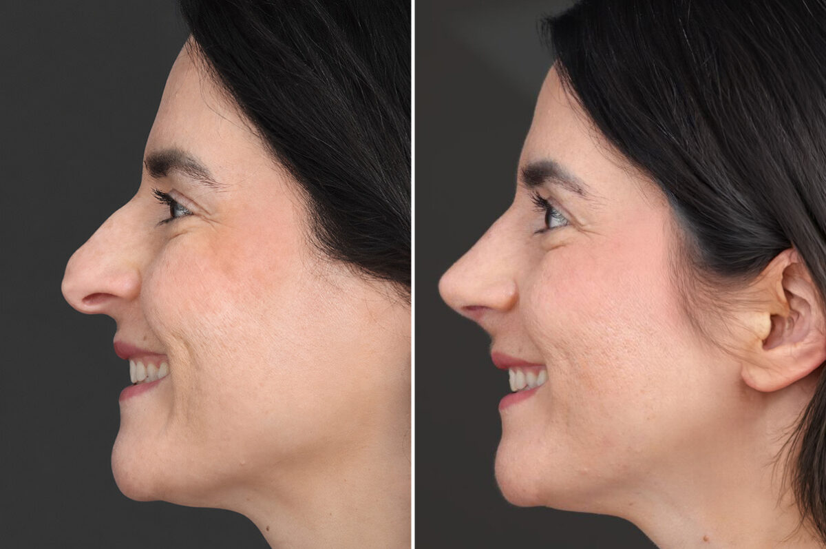 Rhinoplasty Before and After Photos in Princeton, NJ, Patient 22362