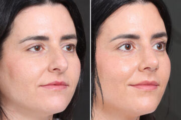 Rhinoplasty Before and After Photos in Princeton, NJ, Patient 22362