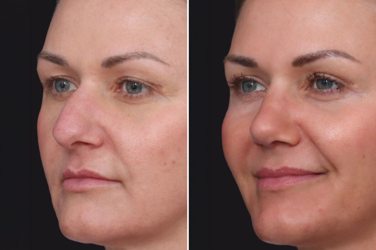 Rhinoplasty Before and After Photos in Princeton, NJ, Patient 22366