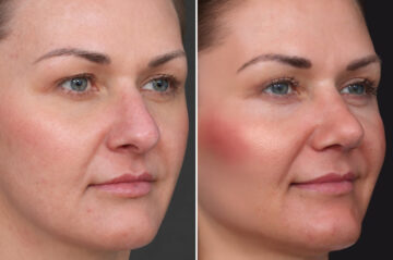 Rhinoplasty Before and After Photos in Princeton, NJ, Patient 22366