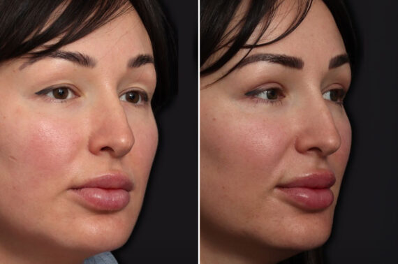 Upper Eyelid Surgery Before and After Photos in Princeton, NJ, Patient 22369