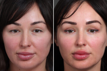 Upper Eyelid Surgery Before and After Photos in Princeton, NJ, Patient 22369