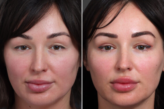 Upper Eyelid Surgery Before and After Photos in Princeton, NJ, Patient 22369