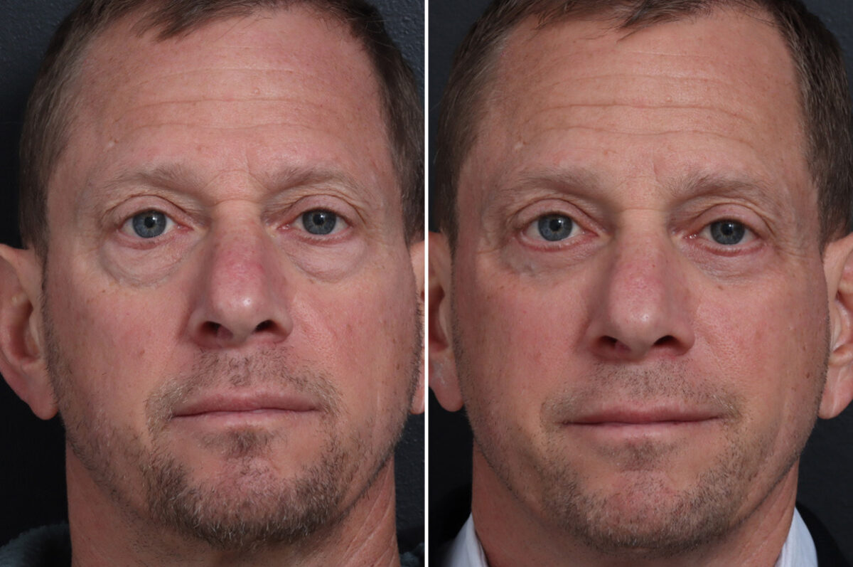 Lower Eyelid Surgery Before and After Photos in Princeton, NJ, Patient 22372