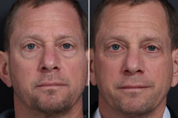 Lower Eyelid Surgery Before and After Photos in Princeton, NJ, Patient 22372