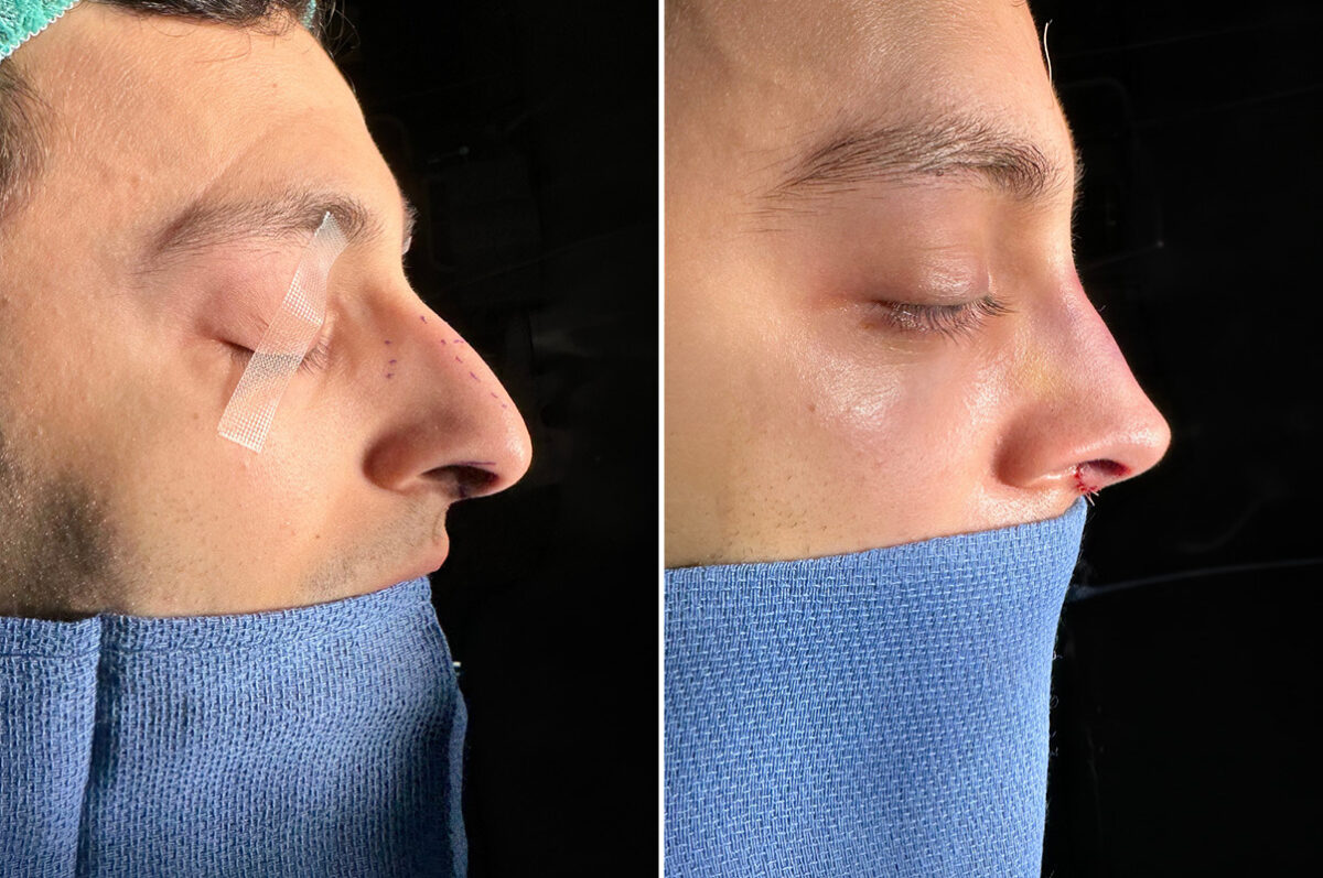 Rhinoplasty Before and After Photos in Princeton, NJ, Patient 22374