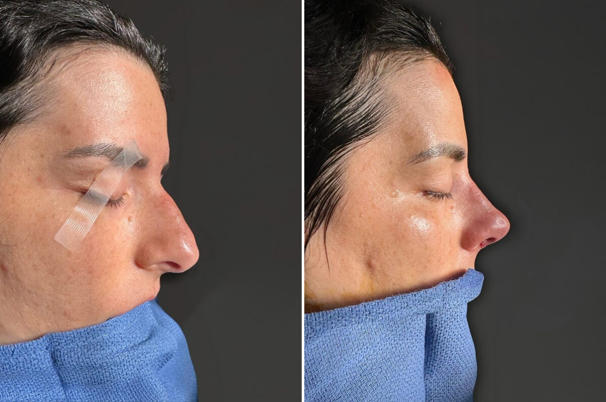Rhinoplasty Before and After Photos in Princeton, NJ, Patient 22374