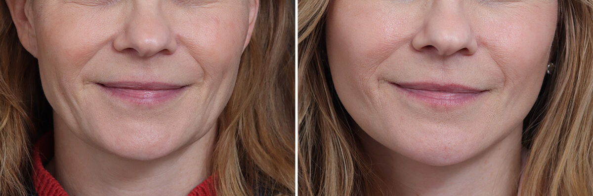 Facelift Before and After Photos in Princeton, NJ, Patient 22818
