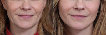 Facelift Before and After Photos in Princeton, NJ, Patient 22818