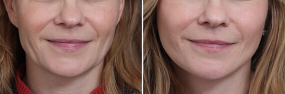 Facelift Before and After Photos in Princeton, NJ, Patient 22818