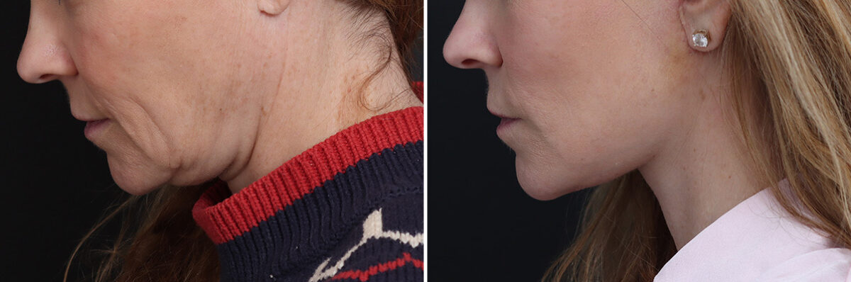 Facelift Before and After Photos in Princeton, NJ, Patient 22818