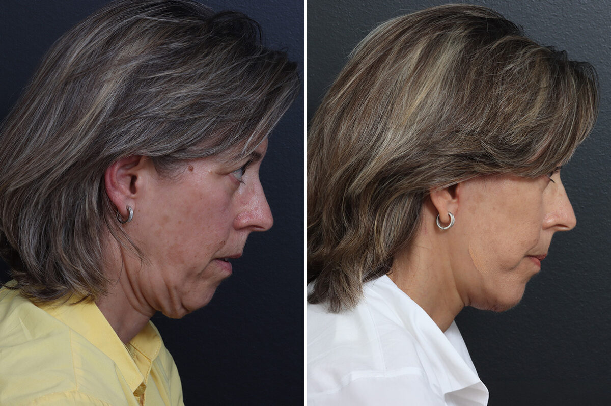 Facelift Before and After Photos in Princeton, NJ, Patient 22863