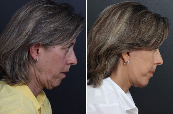 Facelift Before and After Photos in Princeton, NJ, Patient 22863