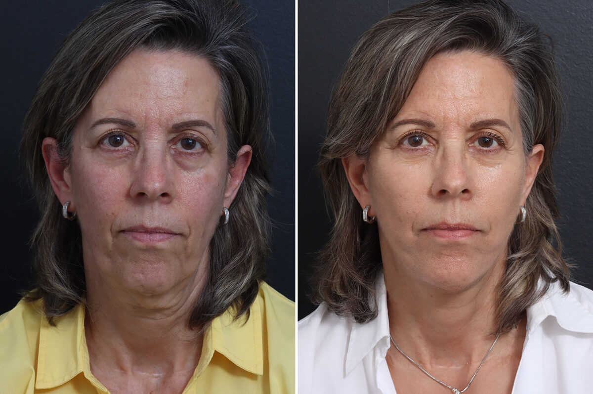 Facelift Before and After Photos in Princeton, NJ, Patient 22863