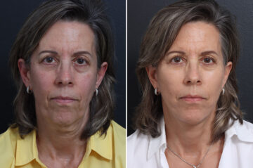 Facelift Before and After Photos in Princeton, NJ, Patient 22863