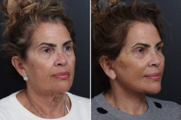 Facelift Before and After Photos in Princeton, NJ, Patient 22866
