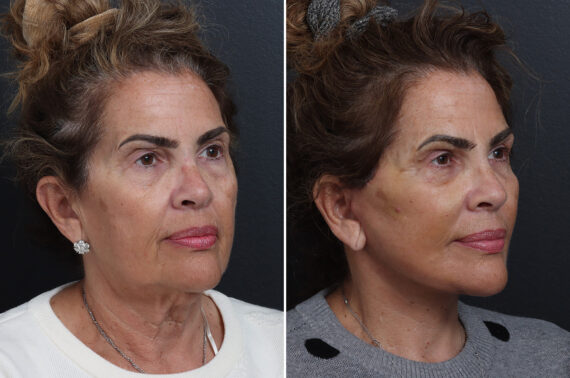 Facelift Before and After Photos in Princeton, NJ, Patient 22866