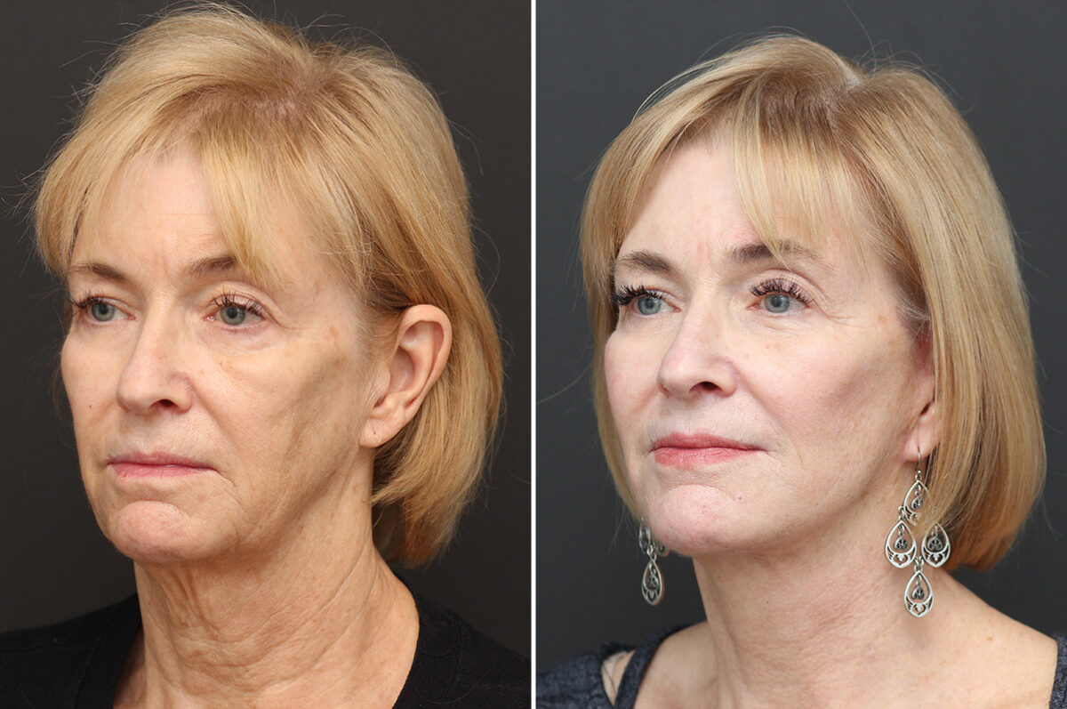 Facelift Before and After Photos in Princeton, NJ, Patient 22872