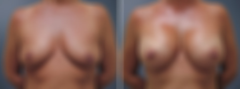 Breast Augmentation Before and After Photos in Princeton, NJ, Patient 23013