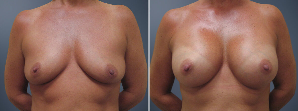 Breast Augmentation Before and After Photos in Princeton, NJ, Patient 23013