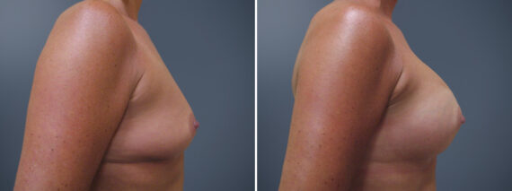 Breast Augmentation Before and After Photos in Princeton, NJ, Patient 23013
