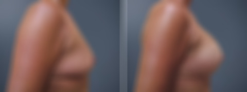 Breast Augmentation Before and After Photos in Princeton, NJ, Patient 23013