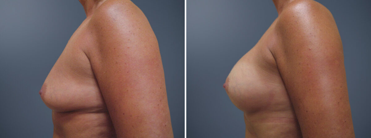 Breast Augmentation Before and After Photos in Princeton, NJ, Patient 23013