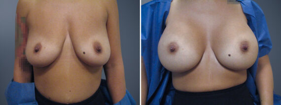 Breast Augmentation Before and After Photos in Princeton, NJ, Patient 23023