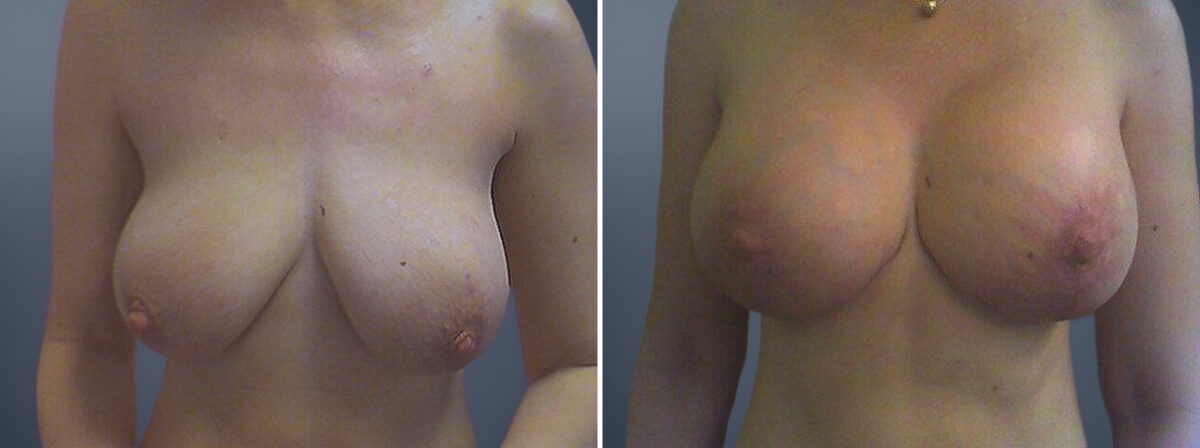 Breast Augmentation Before and After Photos in Princeton, NJ, Patient 23044